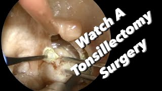 Tonsillectomy Surgery  actual footage [upl. by Majka126]