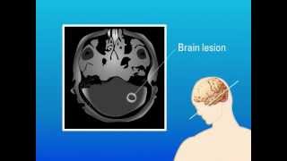 Extrapulmonary Aspergillosis – Type of Fungal Infection [upl. by Ettennat]