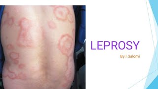 Leprosy in tamil  etiology  microbiologypathology all clinical features [upl. by Leafar]