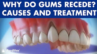 Gum recession  Treatment of gingival retraction © [upl. by Eyaj843]