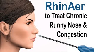 RhinAer to Treat Chronic Runny Nose and Congestion [upl. by Stella224]