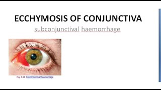 Ophthalmology Ecchymosis of Conjunctiva SubConjunctival Hemorrhage Blood red eye [upl. by Anaib]