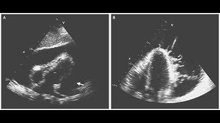 Tuberkulöse Perikarditis mit Perikardtamponade [upl. by Andrei986]