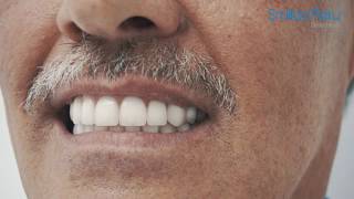 Implante Dental Peru  Prótesis sobre Implantes Dentales  Smiles Peru [upl. by Aicenev]