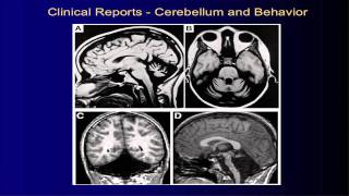 UNM Department of Psychiatry Grand Rounds Jeremy D Schmahmann MD [upl. by Madelene623]