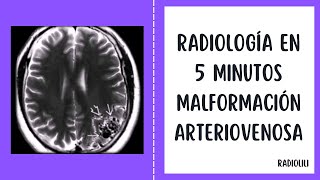 Radiología en 5 minutos Malformación Arteriovenosa [upl. by Berhley]