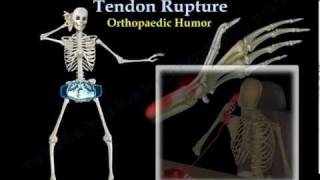 Rupture of the Extensor Pollicis Longus Tendon  Everything You Need To Know  Dr Nabil Ebraheim [upl. by Nrehtac]