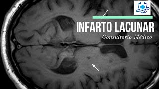 Infarto Lacunar Causas Síntomas y Tratamiento 👨‍⚕️ Consultorio Médico [upl. by Oiratnom]