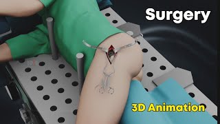 SuperPath Hip Replacement Surgery  3D Animation [upl. by Marleah]