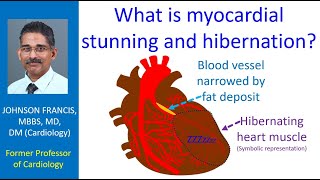 What is myocardial stunning and hibernation [upl. by Relluf158]