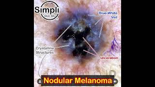 Nodular Melanoma Dermoscopy [upl. by Ahsatsana631]