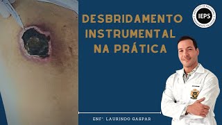 DESBRIDAMENTO INSTRUMENTAL DE FERIDA escara NA PRÁTICA [upl. by Leisha529]