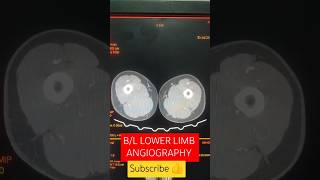 BL LOWER LIMB ANGIO youtubeshorts viralshorts hemantkushwah3453 [upl. by Thomsen]