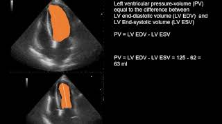 Echocardiography in the patient with acute anteroseptal myocardial infarction [upl. by Willy]