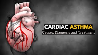 Cardiac Asthma Causes Signs and Symptoms Diagnosis and Treatment [upl. by Noell902]