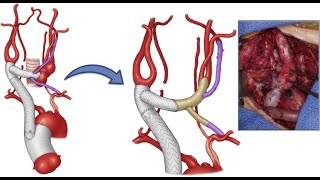 What Is Takayasu Arteritis  Symptoms Complications amp Treatment Methods [upl. by Ynohtnaleahcim]