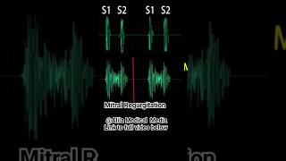 Heart Murmurs Mitral Valve Regurgitation heartmurmurs medicalanimation [upl. by Enaj]