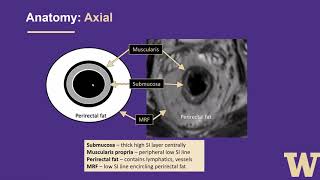 MRI Rectal Cancer TNM Staging [upl. by Assitruc]