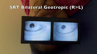 Right Sided Geotropic Horizontal Canal BPPV [upl. by Spoor]