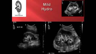 Hydronephrosis Point of Care Ultrasound [upl. by Willdon941]