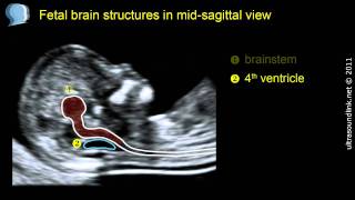 Normal fetal brain anatomy at 1113 weeks  2D scan [upl. by Herc323]