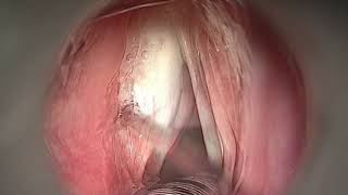 PHONOSURGERY  LEFT VOCAL FOLD PALSY [upl. by Arlen]