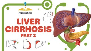 Liver cirrhosis part 2 [upl. by Rimisac]