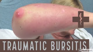 traumatic bursitis [upl. by Charlean415]