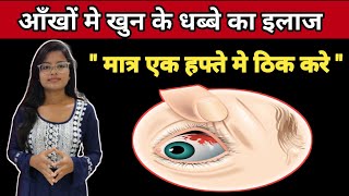 Sub Cunjuctiva Hemorrhage Treatment  Ankho Me khun ke Lal Dhabbe Ka Ilaz  In Hindi [upl. by Janelle959]