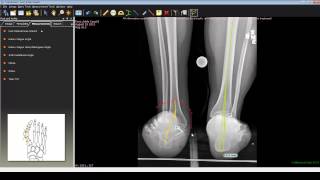 Foot and Ankle Deformity Correction with Dr Noman Siddiqui  Hindfoot Deformity [upl. by Ballard299]