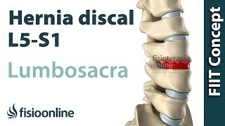 Hernia discal lumbar entre la L5 y S1 o quinta vértebra lumbar y el sacro [upl. by Sheff]