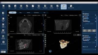 FinScan F350 Mandibular Nerve Canal Marking [upl. by Orth]