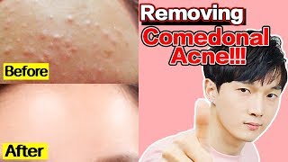 NO AD Remove Comedonal Acne Cosmetics and Ointments [upl. by Thilde]