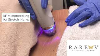 RF microneedling for stretch marks [upl. by Hpesoj161]