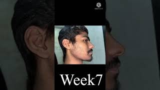 Kirkland minoxidil beard journey week 7 transformation  Beard solution shorts india [upl. by Rodgers]