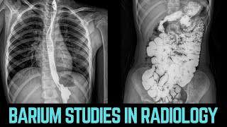 Barium studies in Radiology bariumswallow bariumenema esophagus stomach intestines colon [upl. by Dorweiler433]