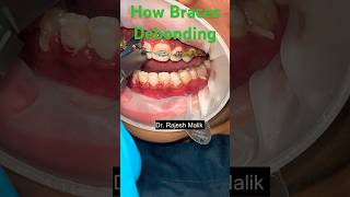 💁🫢How to Braces Debonding shorts trending viral bracesdentist orthodontist smile dental [upl. by Darooge]