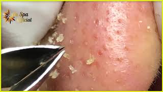 Best Satisfying Nose Plucking Blackheads Whiteheads Removal  Acne Treatment 30 [upl. by Aneba]