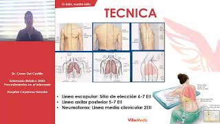 CLASE Nº8  Toracocentesis [upl. by Eusebio]