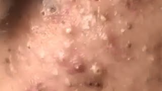 Huge Acne Pimples Blackheads Popping Up Satisfying with Oddly Calm Music [upl. by Ayotahc]