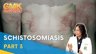 Schistosomiasis Causes Symptoms and Treatment Part 33  Usapang Pangkalusugan [upl. by Hehre771]