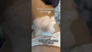 VITILIGO PERMANENT COSMETIC TATTOOING  VITILIGO TREATMENT  vitiligoindia whitespottreatment [upl. by Torrlow39]