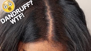 GET RID OF DANDRUFF INSTANTLY IN JUST ONE WASH [upl. by Akemot]