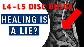 What You Don’t Know About L4L5 Disc Healing Will Shock You  Dr John Zielonka [upl. by Earehs]