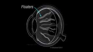 Vitreous 1 Vitreous Aging and Floaters [upl. by Nit]