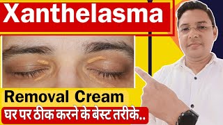 Xanthelasma Removal Cream  How to treat Xanthelasma home Remedies [upl. by Crane380]