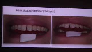 Minimal İnvazif Yöntemlerle Diastema Vakalarının tedavisi  ProfDr Uğur Erdemir [upl. by Lutim177]