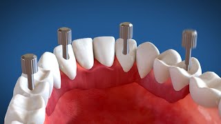 Video Animazione 3D Implantologia dentale a carico immediato Sistema Modulabile [upl. by Modeerf]