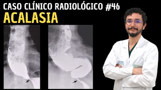 Caso Clínico Radiológico 46 Acalasia [upl. by Irotal777]