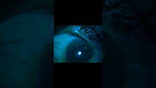 Filamentary keratitis corneal filaments mucoepitheliod strands shorts trending reels [upl. by Novets773]